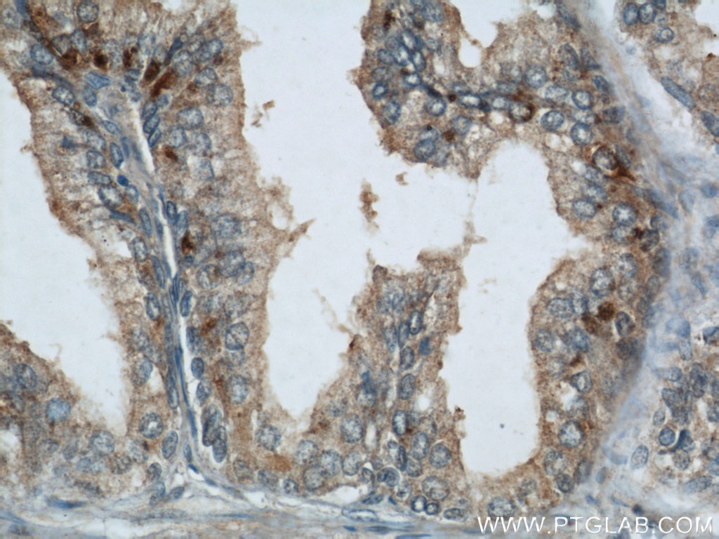Immunohistochemistry (IHC) staining of human prostate hyperplasia tissue using GSK3B Polyclonal antibody (22104-1-AP)