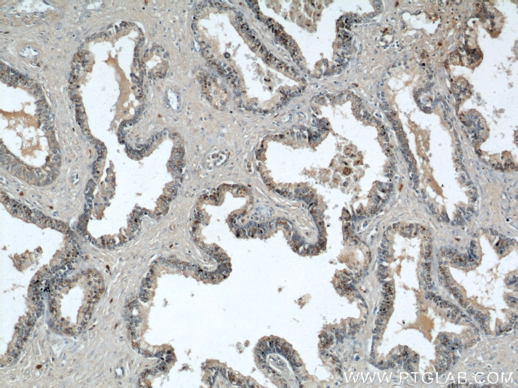 Immunohistochemistry (IHC) staining of human prostate hyperplasia tissue using GSK3B Polyclonal antibody (22104-1-AP)