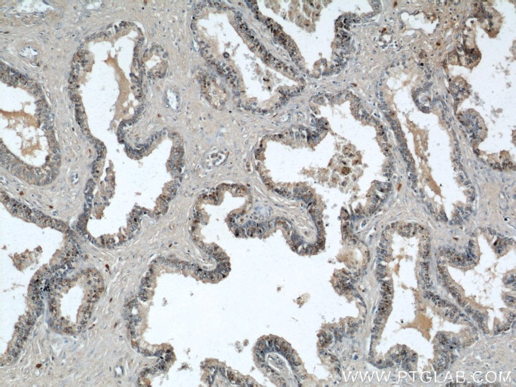 IHC staining of human prostate hyperplasia using 22104-1-AP