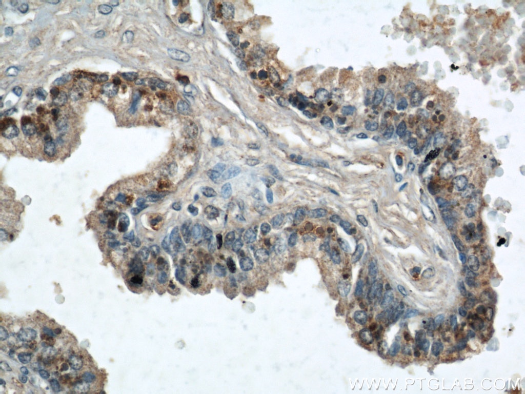 IHC staining of human prostate hyperplasia using 22104-1-AP