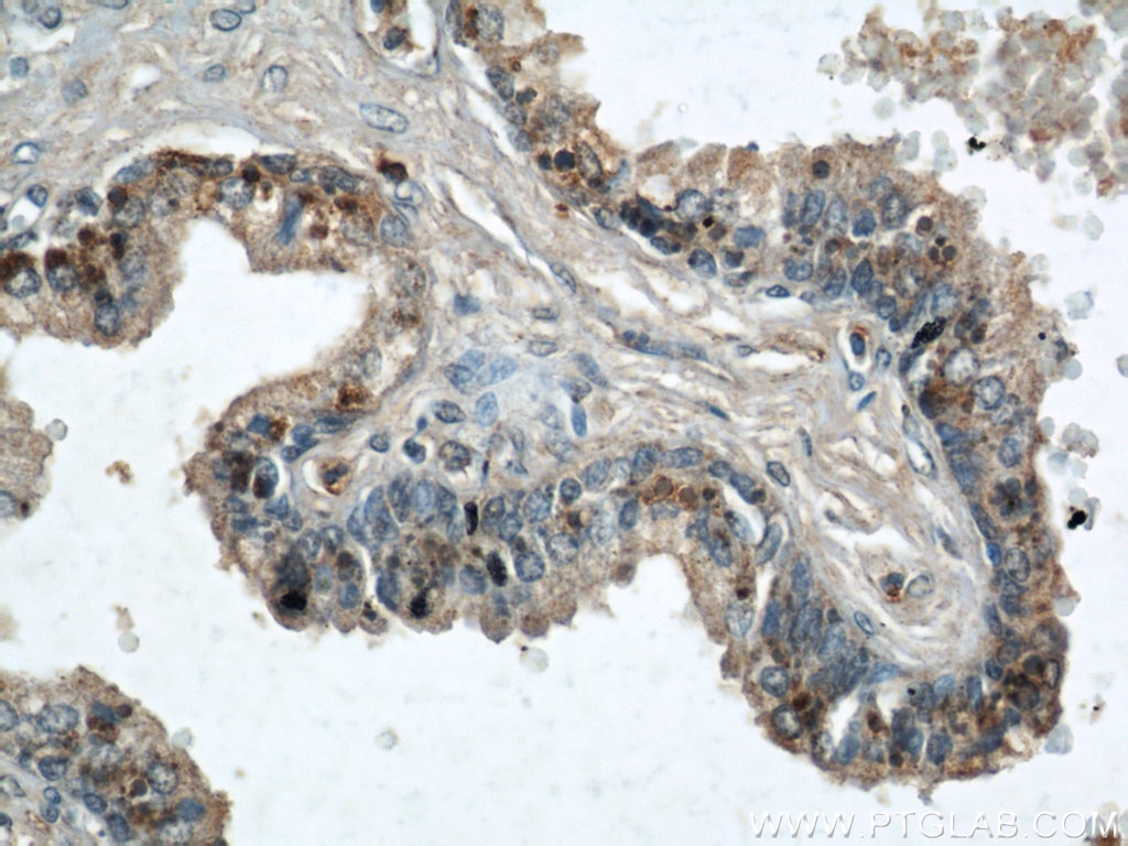 Immunohistochemistry (IHC) staining of human prostate hyperplasia tissue using GSK3B Polyclonal antibody (22104-1-AP)