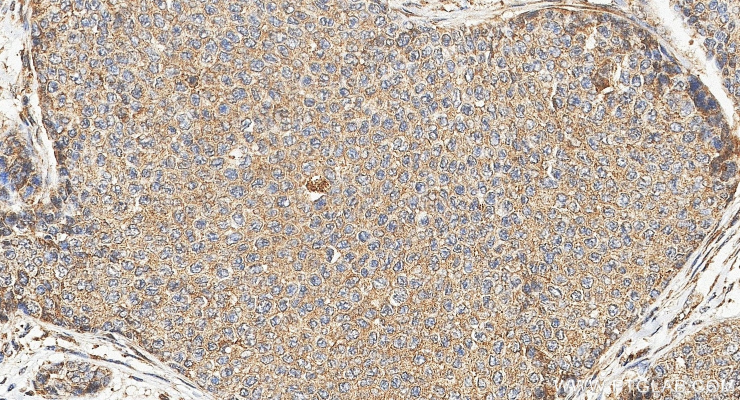 IHC staining of human breast cancer using 51065-1-AP Immunohistochemistry (IHC) staining of human breast cancer tissue using GSK3B Polyclonal antibody (51065-1-AP)