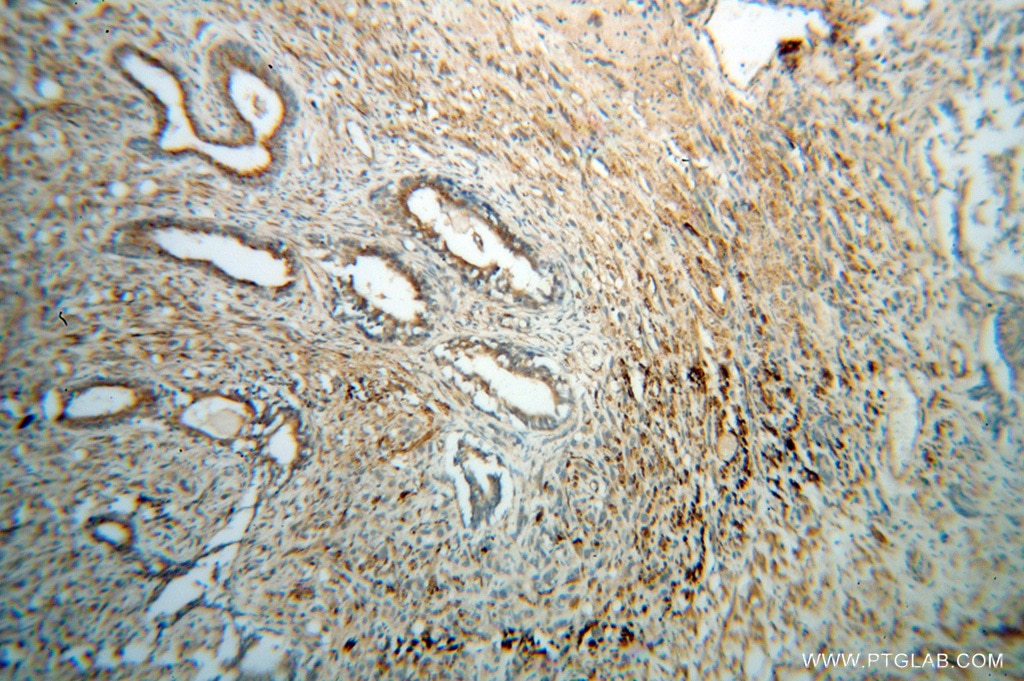 Immunohistochemistry (IHC) staining of human prostate cancer tissue using GSK3B Polyclonal antibody (51065-1-AP)