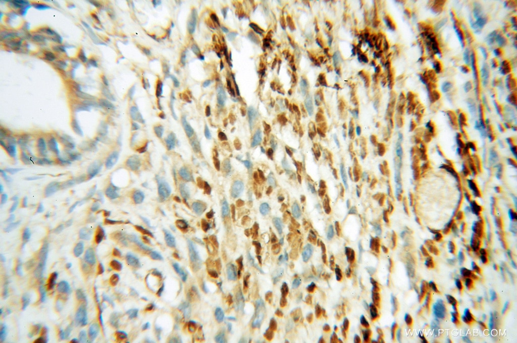 Immunohistochemistry (IHC) staining of human prostate cancer tissue using GSK3B Polyclonal antibody (51065-1-AP)