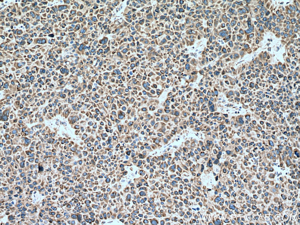 Immunohistochemistry (IHC) staining of human liver cancer tissue using GSK3B Monoclonal antibody (67329-1-Ig)