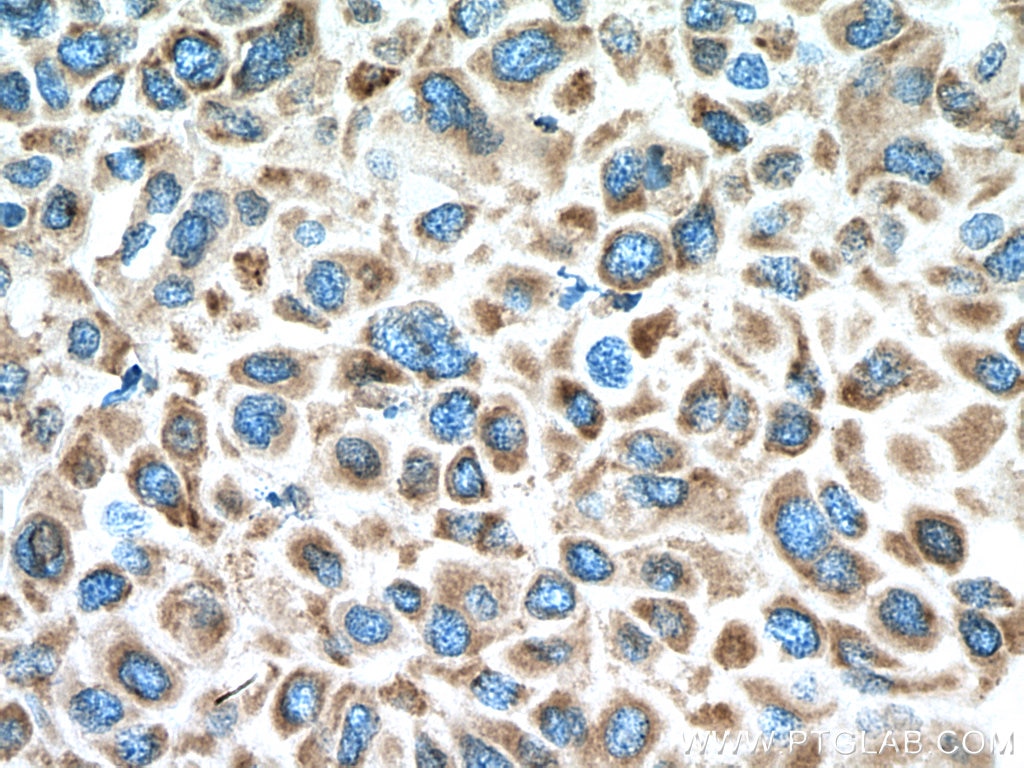 Immunohistochemistry (IHC) staining of human liver cancer tissue using GSK3B Monoclonal antibody (67329-1-Ig)
