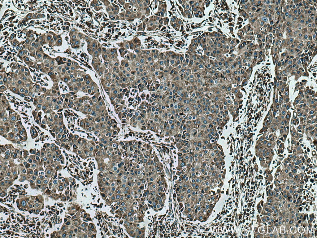 IHC staining of human breast cancer using 67329-1-Ig