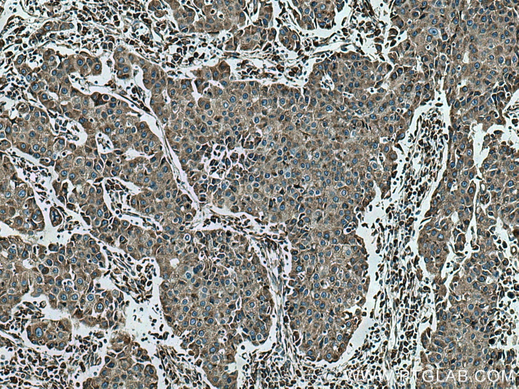 Immunohistochemistry (IHC) staining of human breast cancer tissue using GSK3B Monoclonal antibody (67329-1-Ig)