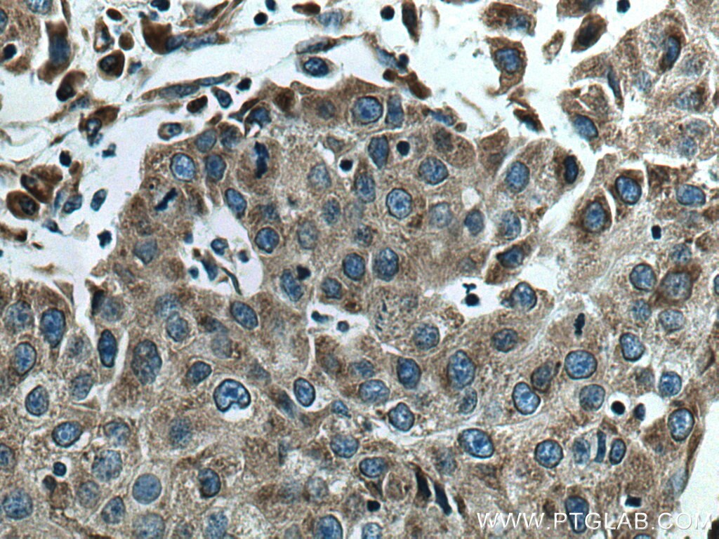 Immunohistochemistry (IHC) staining of human breast cancer tissue using GSK3B Monoclonal antibody (67329-1-Ig)