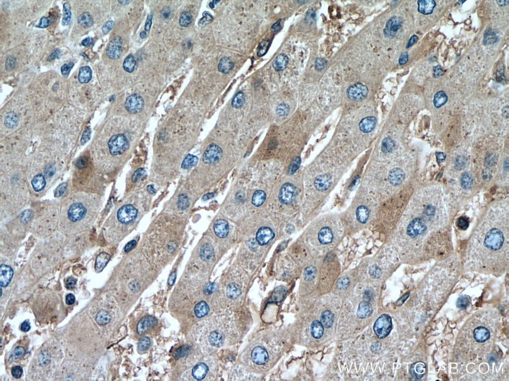 Immunohistochemistry (IHC) staining of human liver cancer tissue using Phospho-GSK3B (Ser9) Monoclonal antibody (67558-1-Ig)
