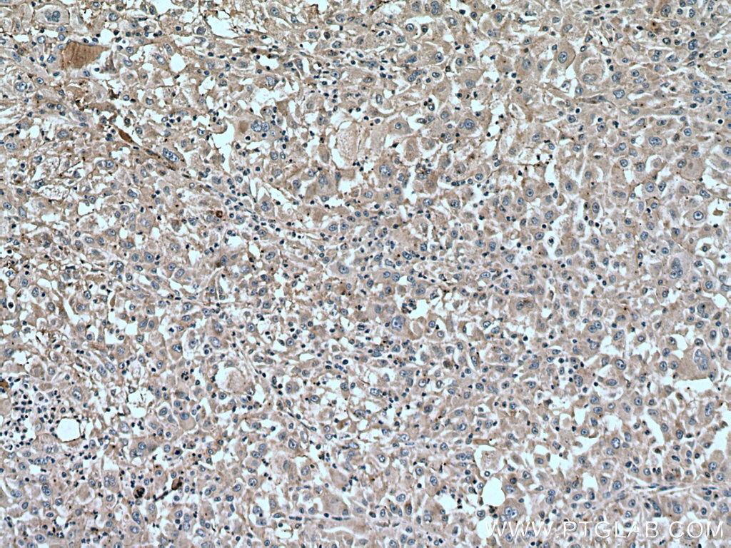 Immunohistochemistry (IHC) staining of human liver cancer tissue using Phospho-GSK3B (Ser9) Monoclonal antibody (67558-1-Ig)