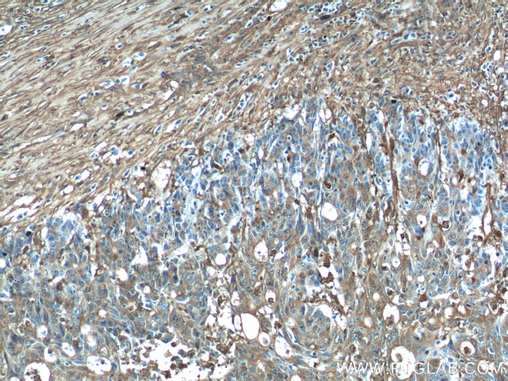 Immunohistochemistry (IHC) staining of human colon cancer tissue using Gelsolin Polyclonal antibody (11644-2-AP)