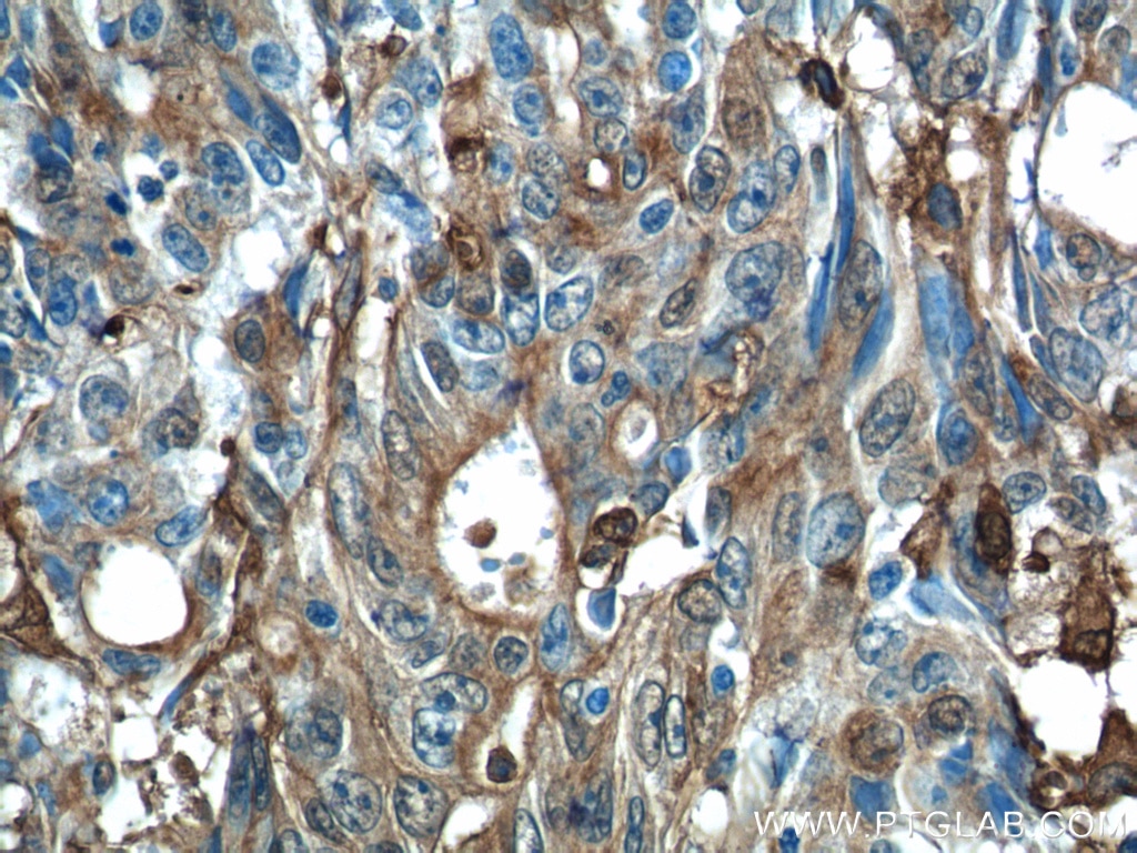 Immunohistochemistry (IHC) staining of human colon cancer tissue using Gelsolin Polyclonal antibody (11644-2-AP)