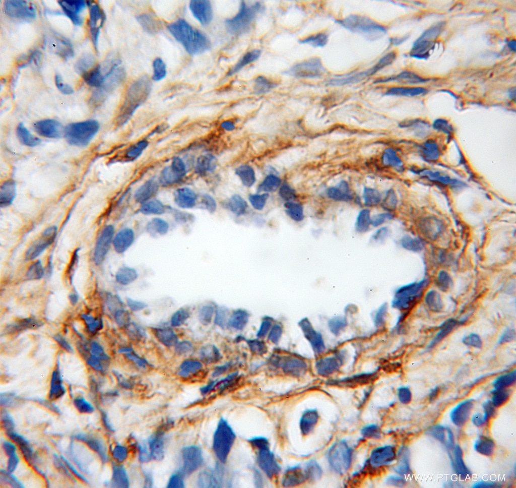 Immunohistochemistry (IHC) staining of human prostate cancer tissue using Gelsolin Polyclonal antibody (11644-2-AP)