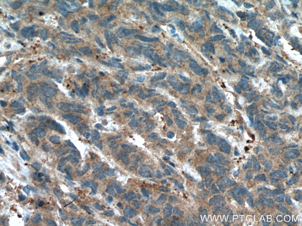 Immunohistochemistry (IHC) staining of human prostate cancer tissue using GSNOR,ADH5 Polyclonal antibody (11051-1-AP)