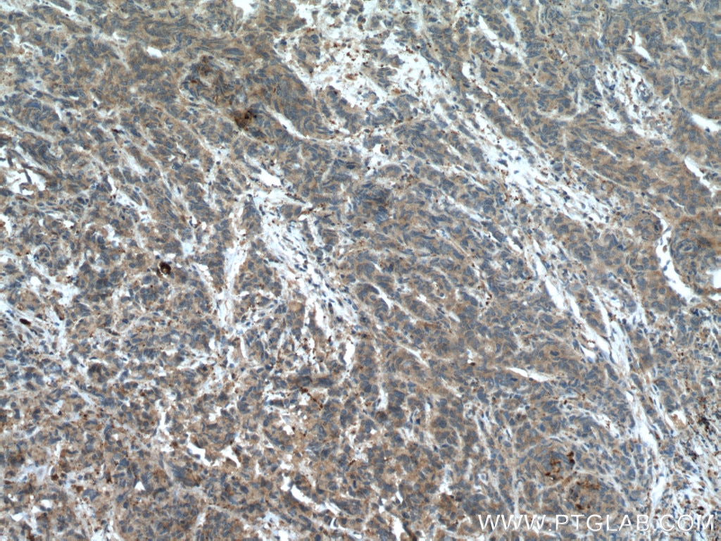 Immunohistochemistry (IHC) staining of human prostate cancer tissue using GSNOR,ADH5 Polyclonal antibody (11051-1-AP)