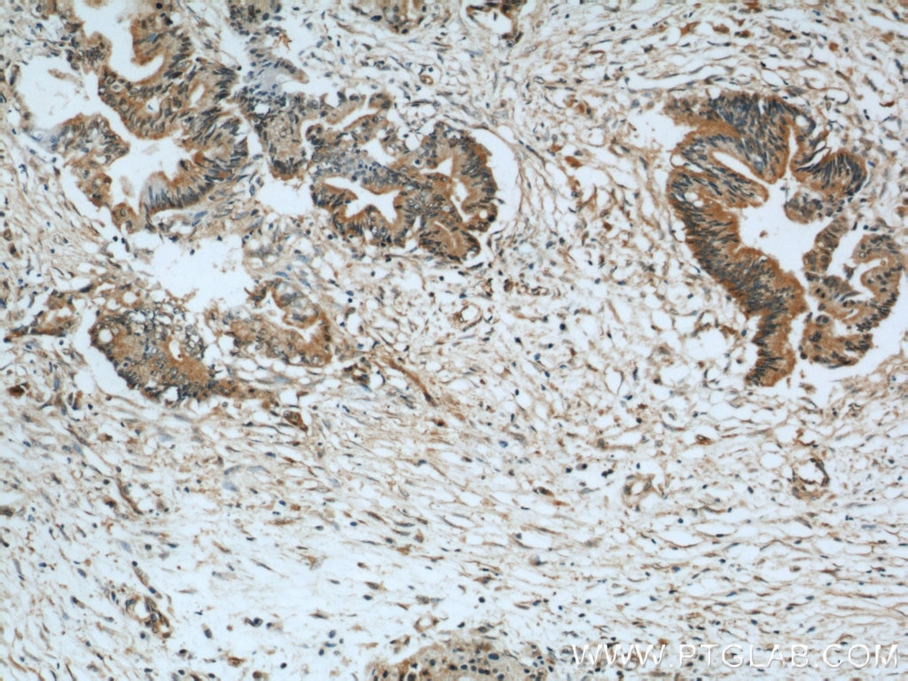 Immunohistochemistry (IHC) staining of human pancreas cancer tissue using GSNOR,ADH5 Polyclonal antibody (16379-1-AP)