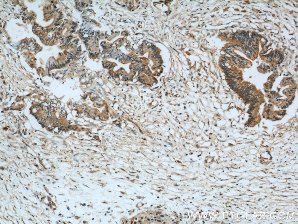 IHC staining of human pancreas cancer using 16379-1-AP