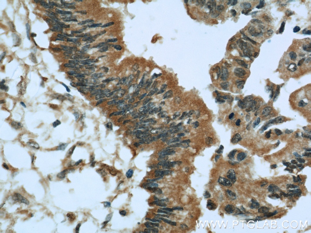 Immunohistochemistry (IHC) staining of human pancreas cancer tissue using GSNOR,ADH5 Polyclonal antibody (16379-1-AP)
