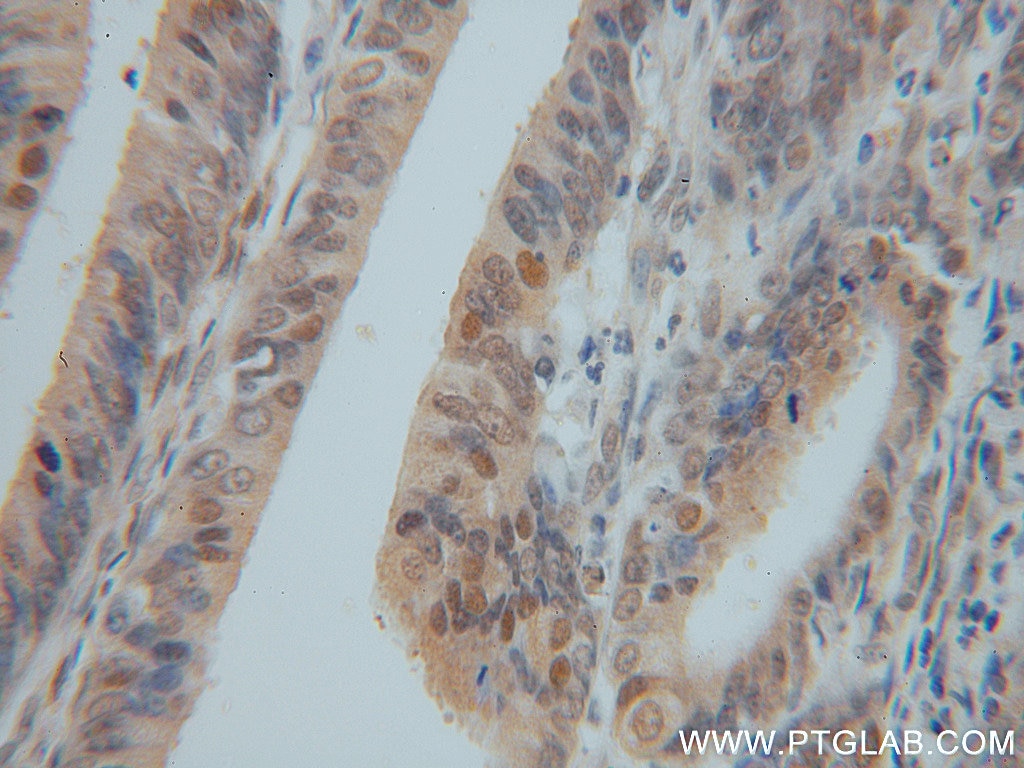 IHC staining of human endometrial cancer using 16379-1-AP