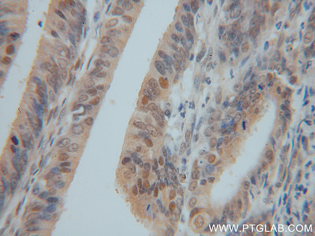 Immunohistochemistry (IHC) staining of human endometrial cancer tissue using GSNOR,ADH5 Polyclonal antibody (16379-1-AP)