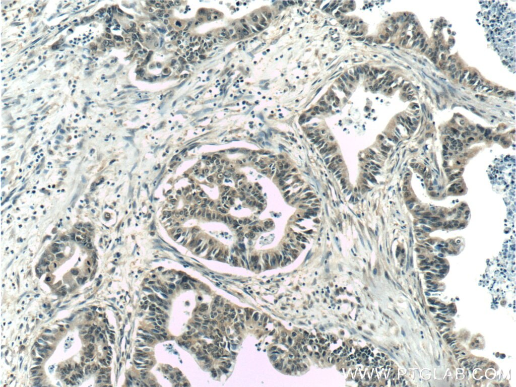 Immunohistochemistry (IHC) staining of human pancreas cancer tissue using GSNOR,ADH5 Monoclonal antibody (66193-1-Ig)