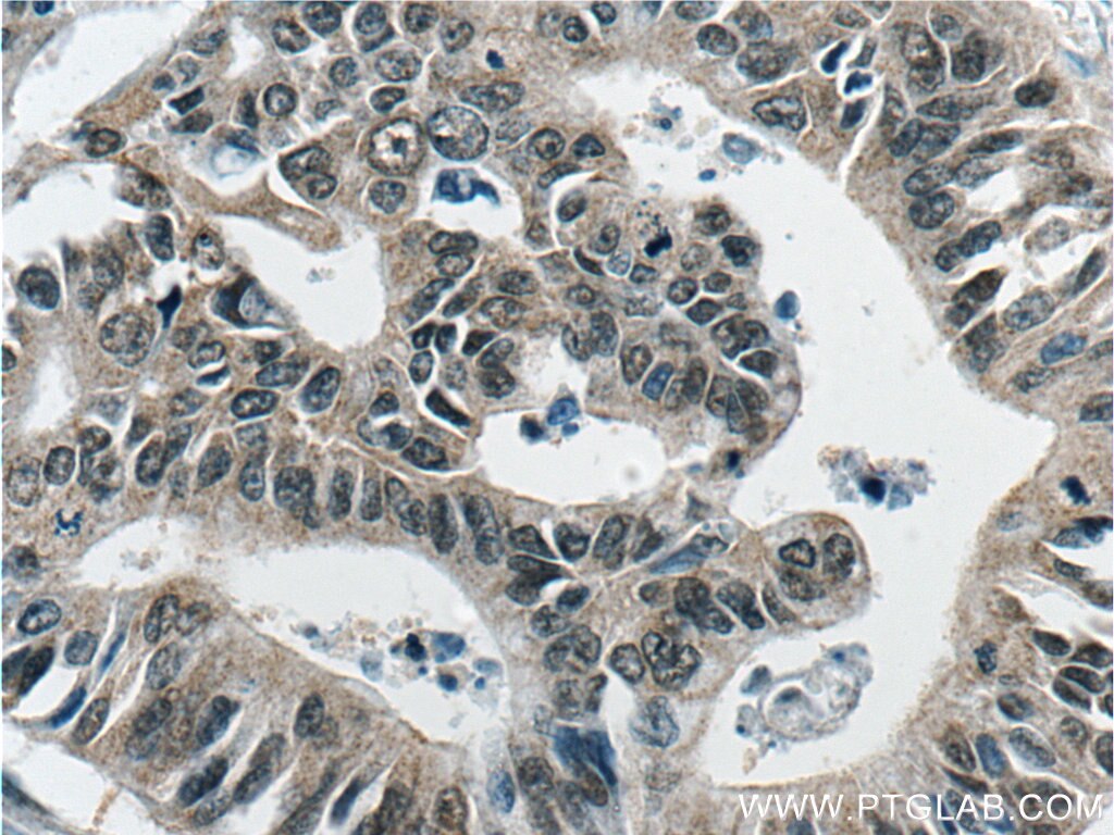 Immunohistochemistry (IHC) staining of human pancreas cancer tissue using GSNOR,ADH5 Monoclonal antibody (66193-1-Ig)