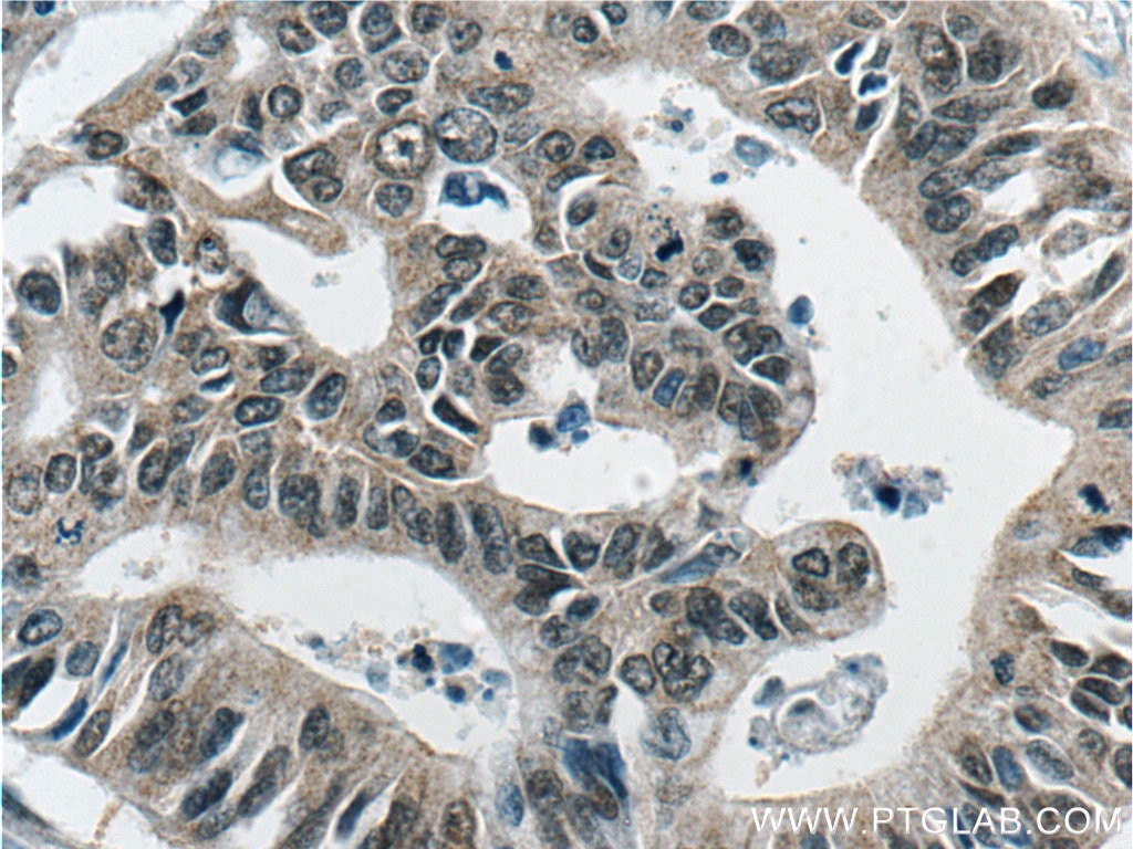 IHC staining of human pancreas cancer using 66193-1-Ig