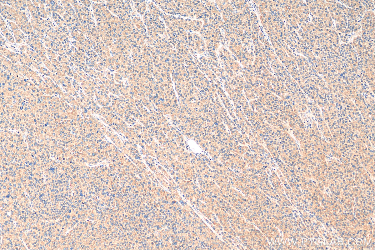 Immunohistochemistry (IHC) staining of human liver cancer tissue using eRF3a/GSPT1 Polyclonal antibody (10763-1-AP)
