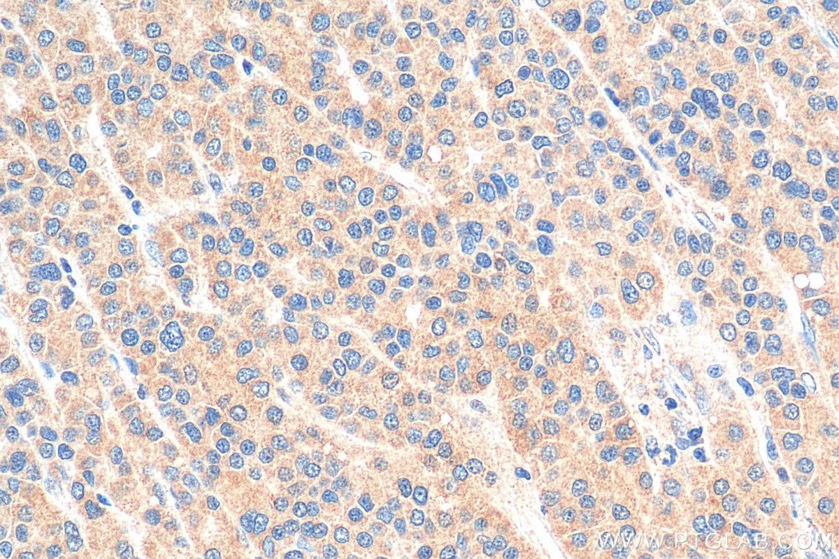IHC staining of human liver cancer using 10763-1-AP