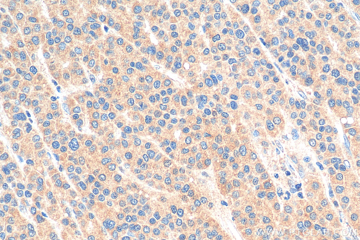 Immunohistochemistry (IHC) staining of human liver cancer tissue using eRF3a/GSPT1 Polyclonal antibody (10763-1-AP)