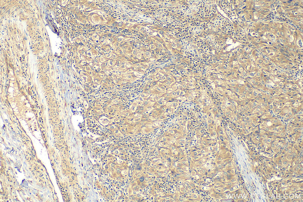 Immunohistochemistry (IHC) staining of human lung cancer tissue using eRF3a/GSPT1 Polyclonal antibody (10763-1-AP)