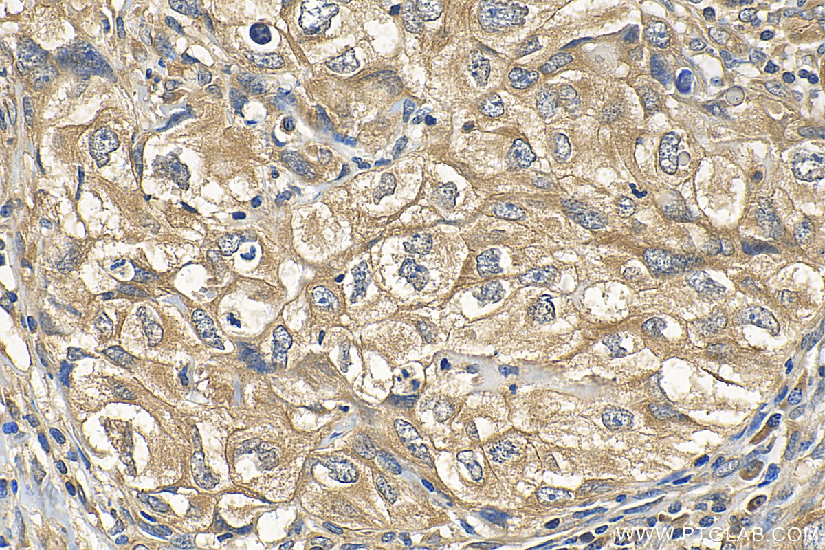 Immunohistochemistry (IHC) staining of human lung cancer tissue using eRF3a/GSPT1 Polyclonal antibody (10763-1-AP)