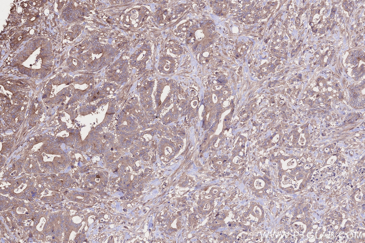 Immunohistochemistry (IHC) staining of human rectal cancer tissue using GSPT2 Polyclonal antibody (12989-1-AP)