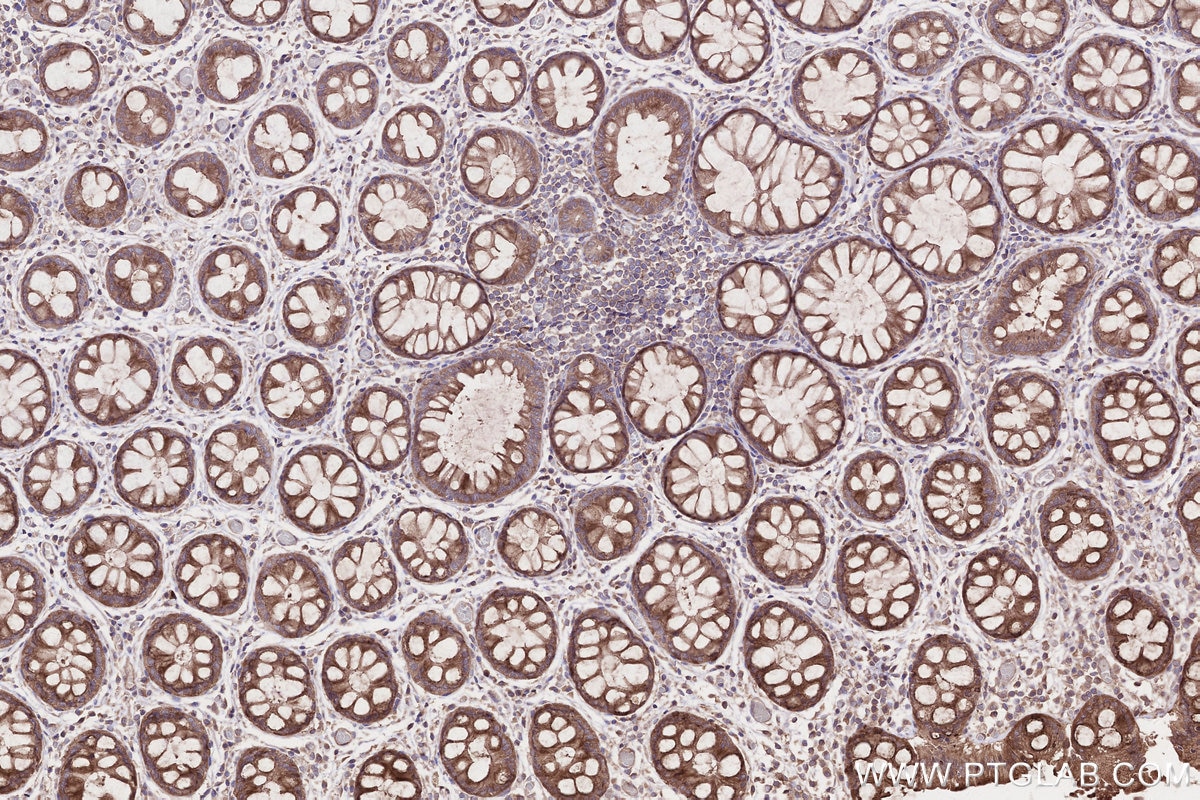 Immunohistochemistry (IHC) staining of human rectal cancer tissue using GSPT2 Polyclonal antibody (12989-1-AP)