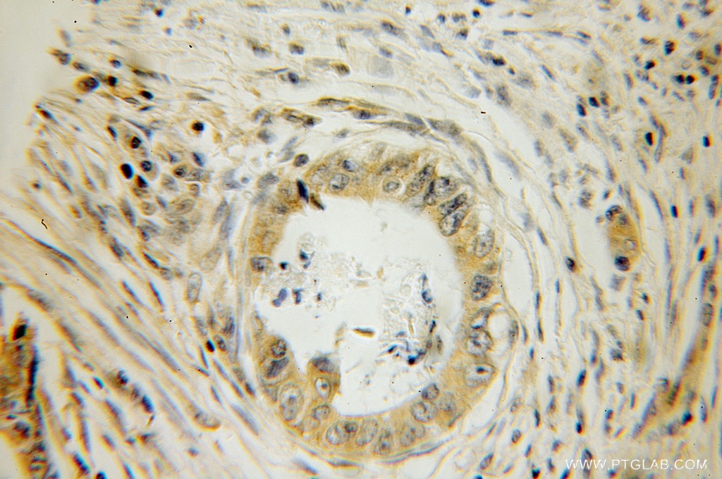 Immunohistochemistry (IHC) staining of human colon cancer tissue using GSPT2 Polyclonal antibody (12989-1-AP)