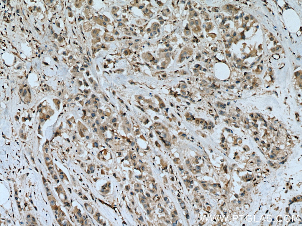 Immunohistochemistry (IHC) staining of human breast cancer tissue using GSR Polyclonal antibody (18257-1-AP)