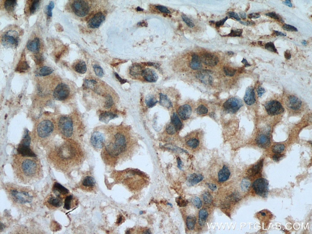 Immunohistochemistry (IHC) staining of human breast cancer tissue using GSR Polyclonal antibody (18257-1-AP)