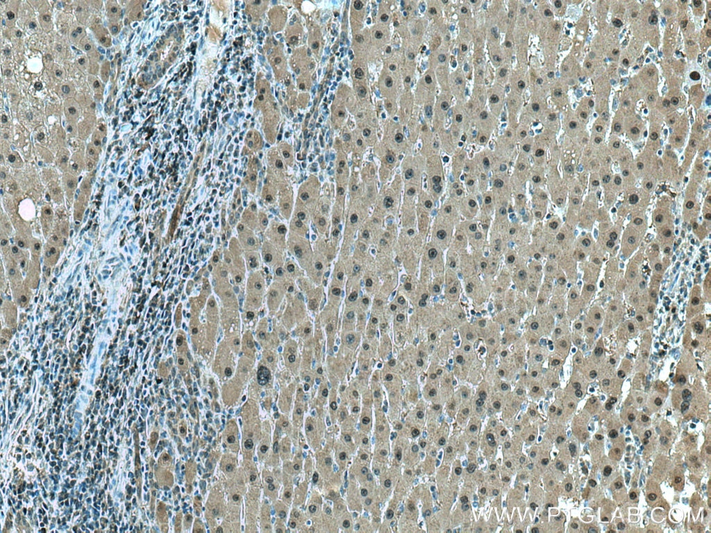 Immunohistochemistry (IHC) staining of human liver cancer tissue using GSS Monoclonal antibody (67598-1-Ig)