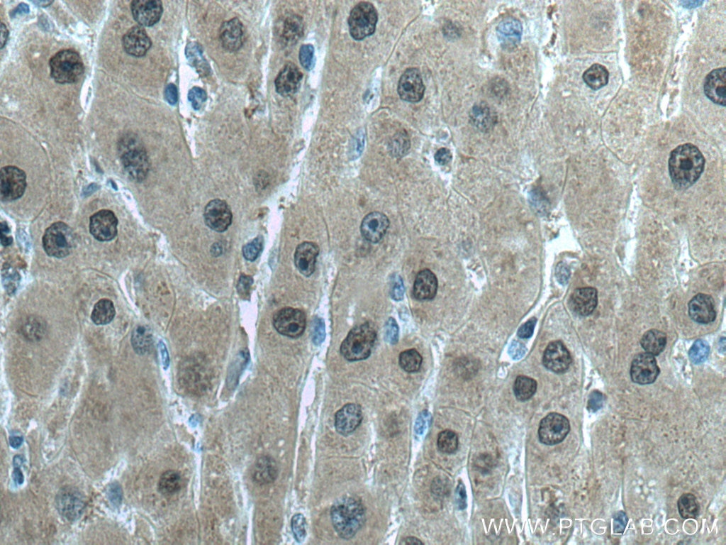 Immunohistochemistry (IHC) staining of human liver cancer tissue using GSS Monoclonal antibody (67598-1-Ig)