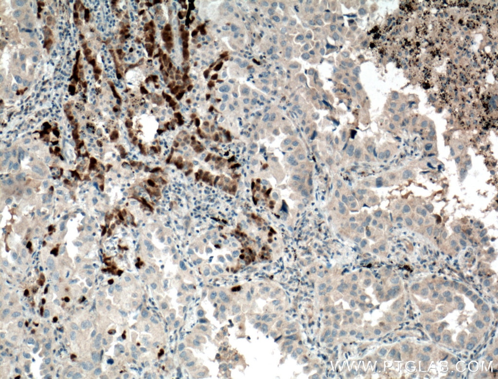 Immunohistochemistry (IHC) staining of human lung cancer tissue using GSTA1 Polyclonal antibody (14475-1-AP)