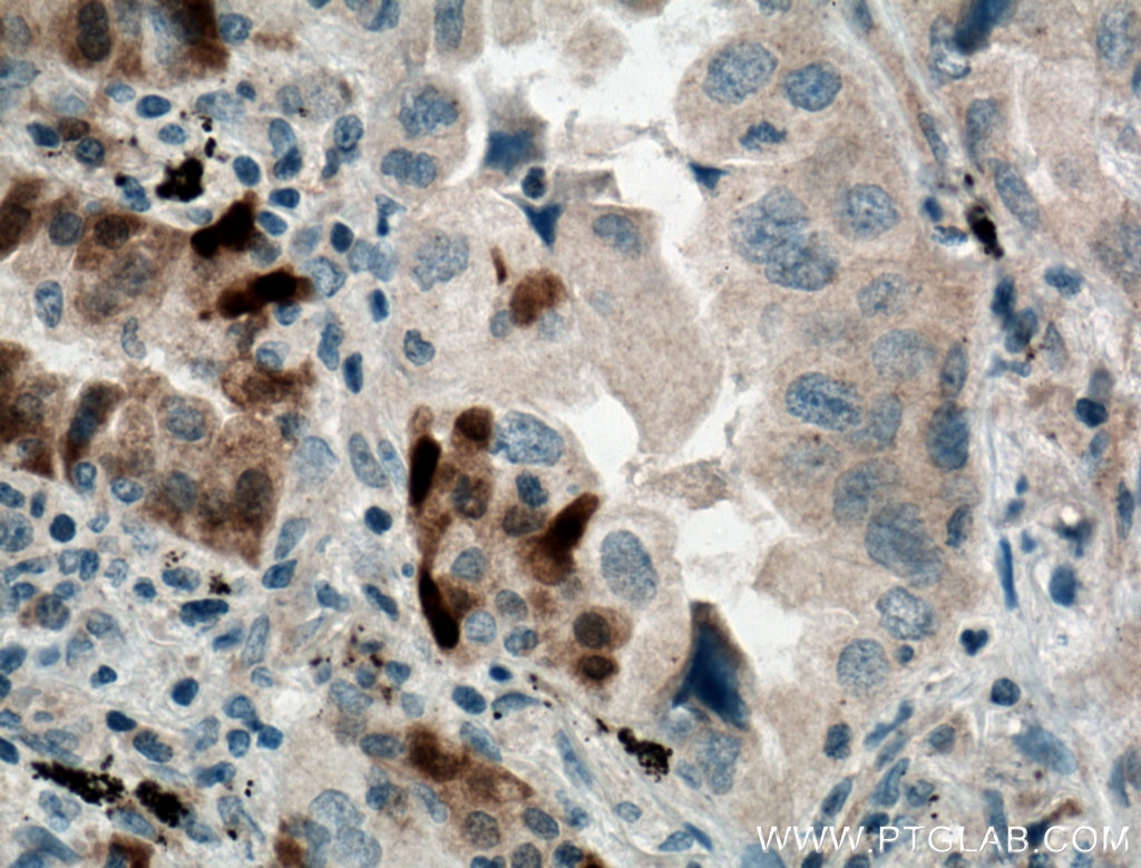 Immunohistochemistry (IHC) staining of human lung cancer tissue using GSTA1 Polyclonal antibody (14475-1-AP)