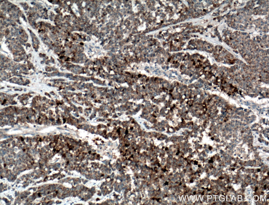 Immunohistochemistry (IHC) staining of human colon cancer tissue using GSTA1 Polyclonal antibody (14475-1-AP)