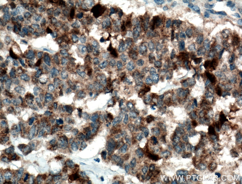 Immunohistochemistry (IHC) staining of human colon cancer tissue using GSTA1 Polyclonal antibody (14475-1-AP)