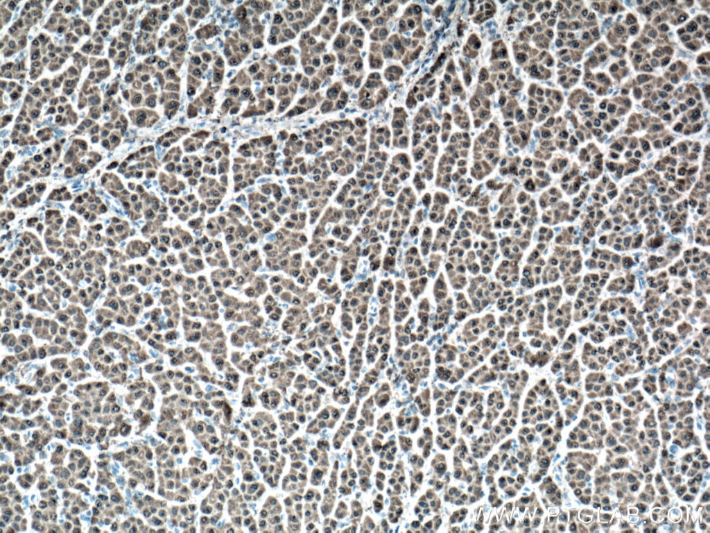 Immunohistochemistry (IHC) staining of human liver cancer tissue using GSTA1 Monoclonal antibody (66624-1-Ig)