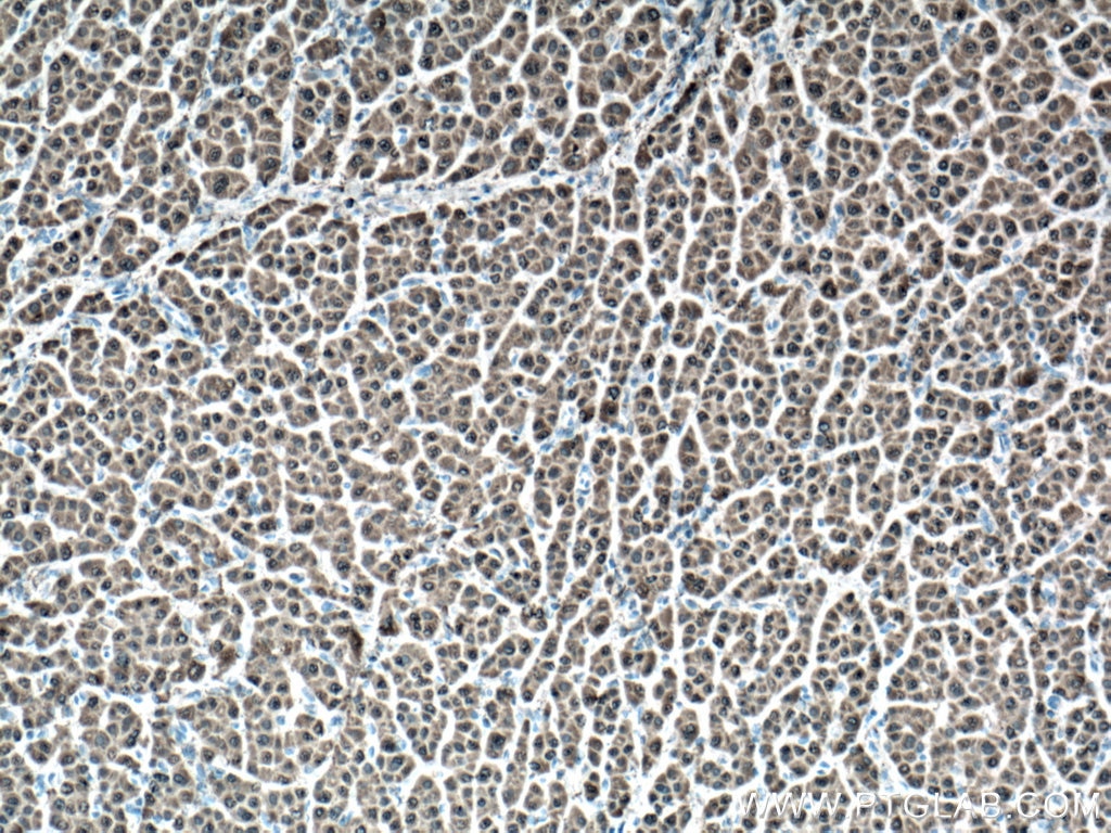 IHC staining of human liver cancer using 66624-1-Ig