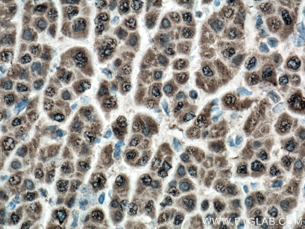 IHC staining of human liver cancer using 66624-1-Ig