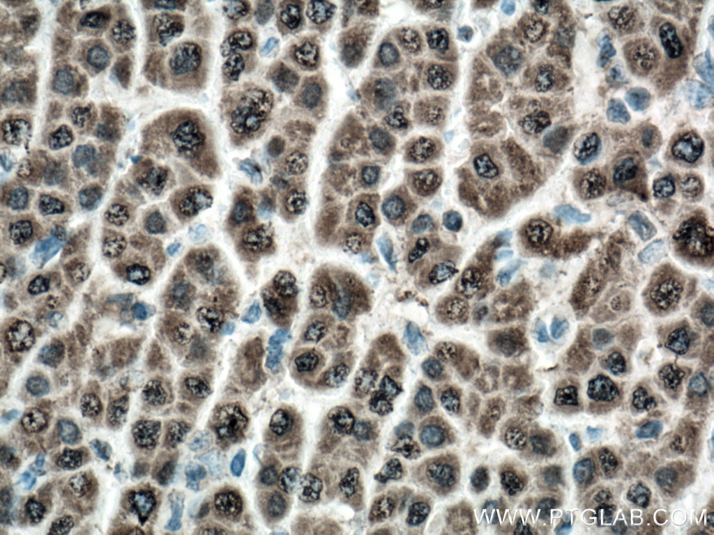 Immunohistochemistry (IHC) staining of human liver cancer tissue using GSTA1 Monoclonal antibody (66624-1-Ig)