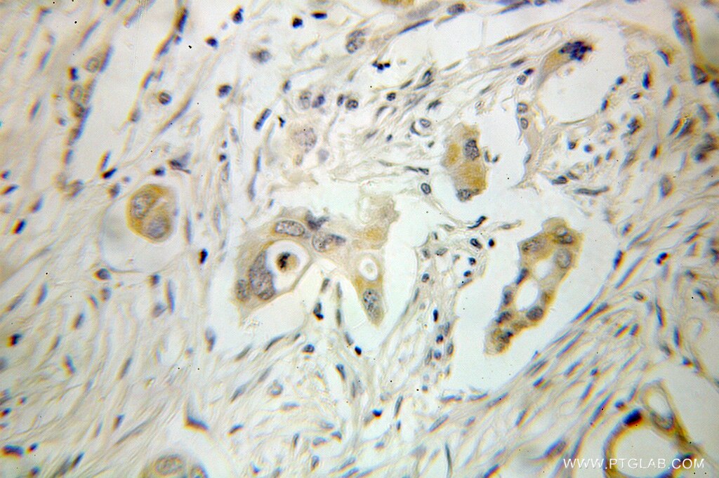 Immunohistochemistry (IHC) staining of human pancreas cancer tissue using GSTA2 Polyclonal antibody (10505-1-AP)