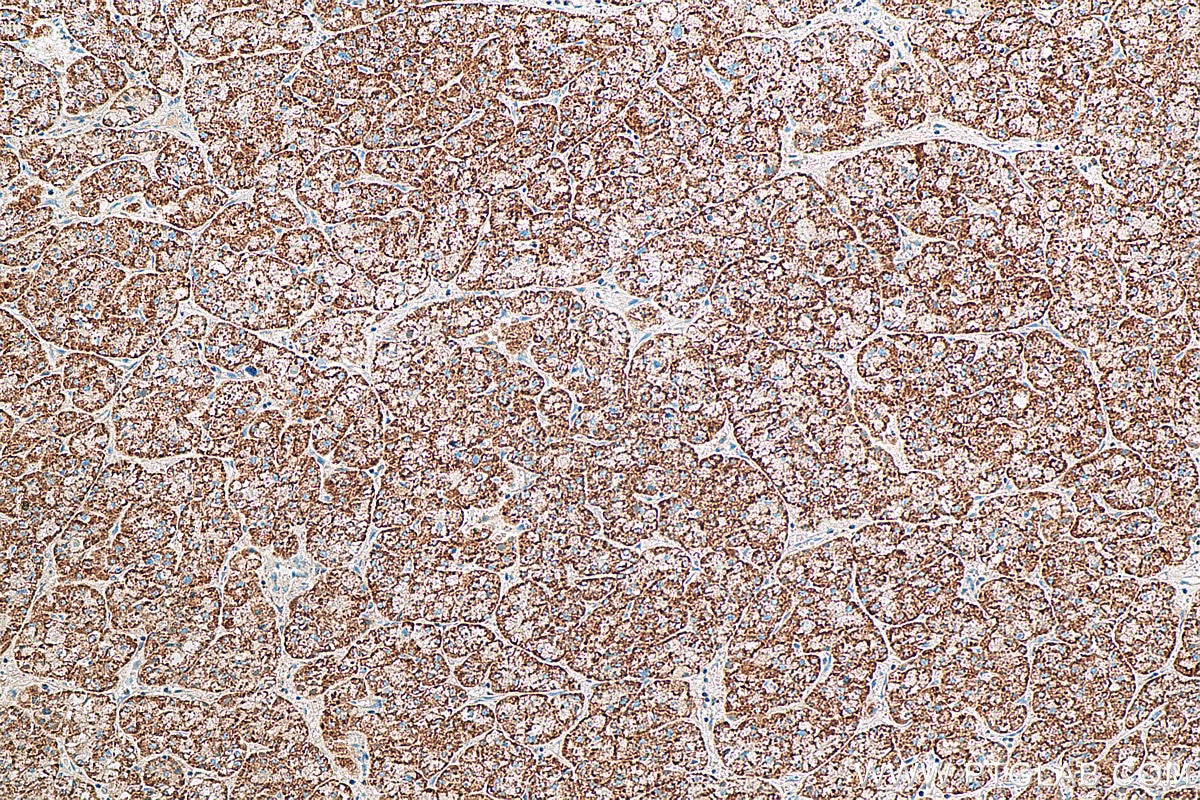Immunohistochemistry (IHC) staining of human liver cancer tissue using GSTK1 Polyclonal antibody (14535-1-AP)